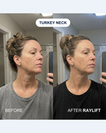 Turkey neck before and after RAYLIFT MicroSeal: mirror selfies of a woman's neck labeled BEFORE and AFTER RAYLIFT, the after side showing shallower horizontal lines and less slack skin under the jaw