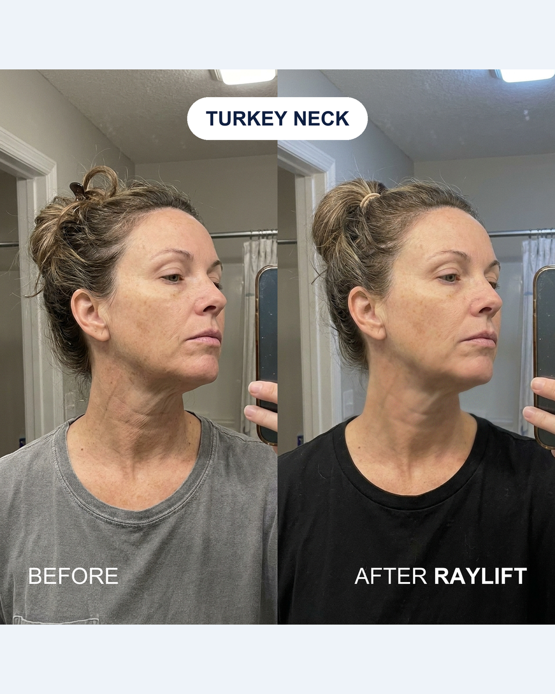 Turkey neck before and after RAYLIFT MicroSeal: mirror selfies of a woman's neck labeled BEFORE and AFTER RAYLIFT, the after side showing shallower horizontal lines and less slack skin under the jaw