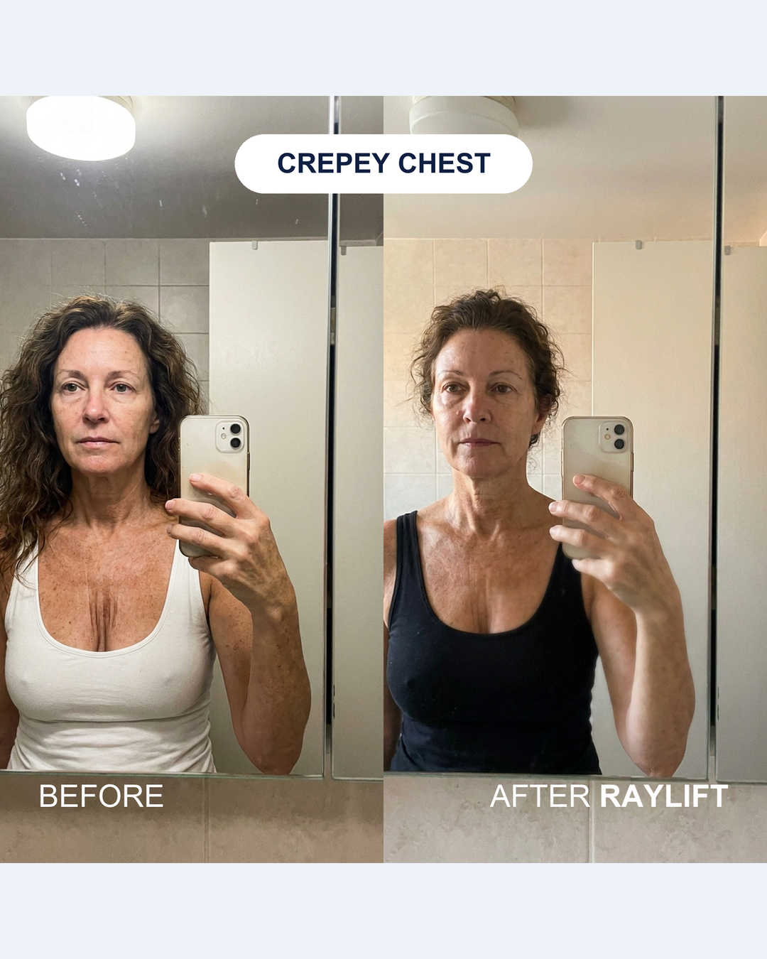 Crepey chest before and after RAYLIFT MicroSeal: mirror selfies of a woman's decollete, the after side showing smoother, less crinkled skin between the collarbones