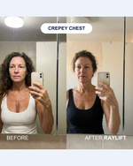 Crepey chest before and after RAYLIFT MicroSeal: mirror selfies of a woman's decollete, the after side showing smoother, less crinkled skin between the collarbones