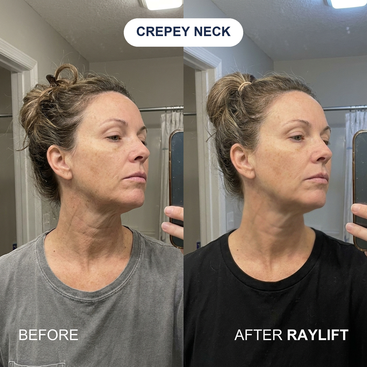 Before and after RAYLIFT MicroSeal on crepey neck
