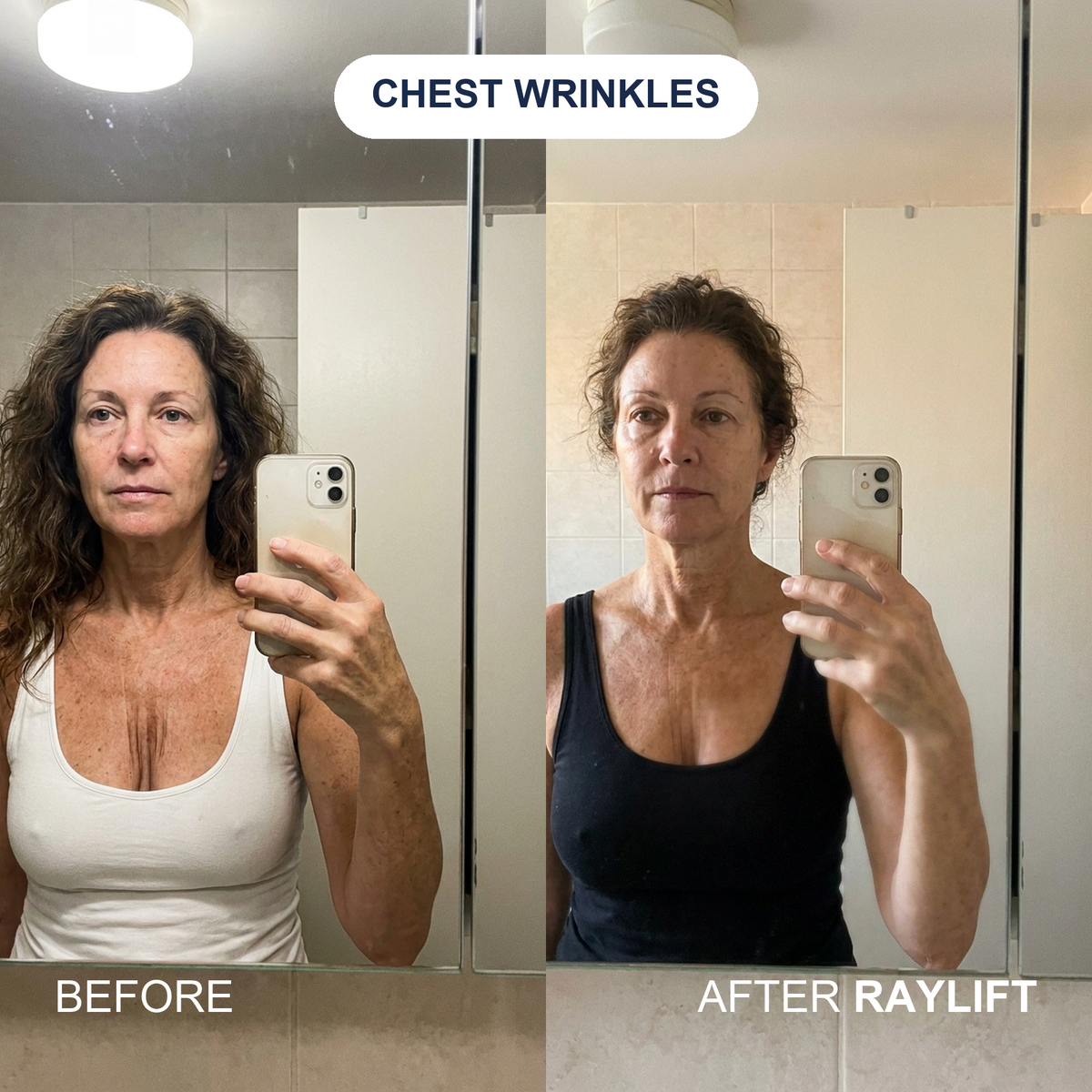 Before and after RAYLIFT MicroSeal on chest wrinkles