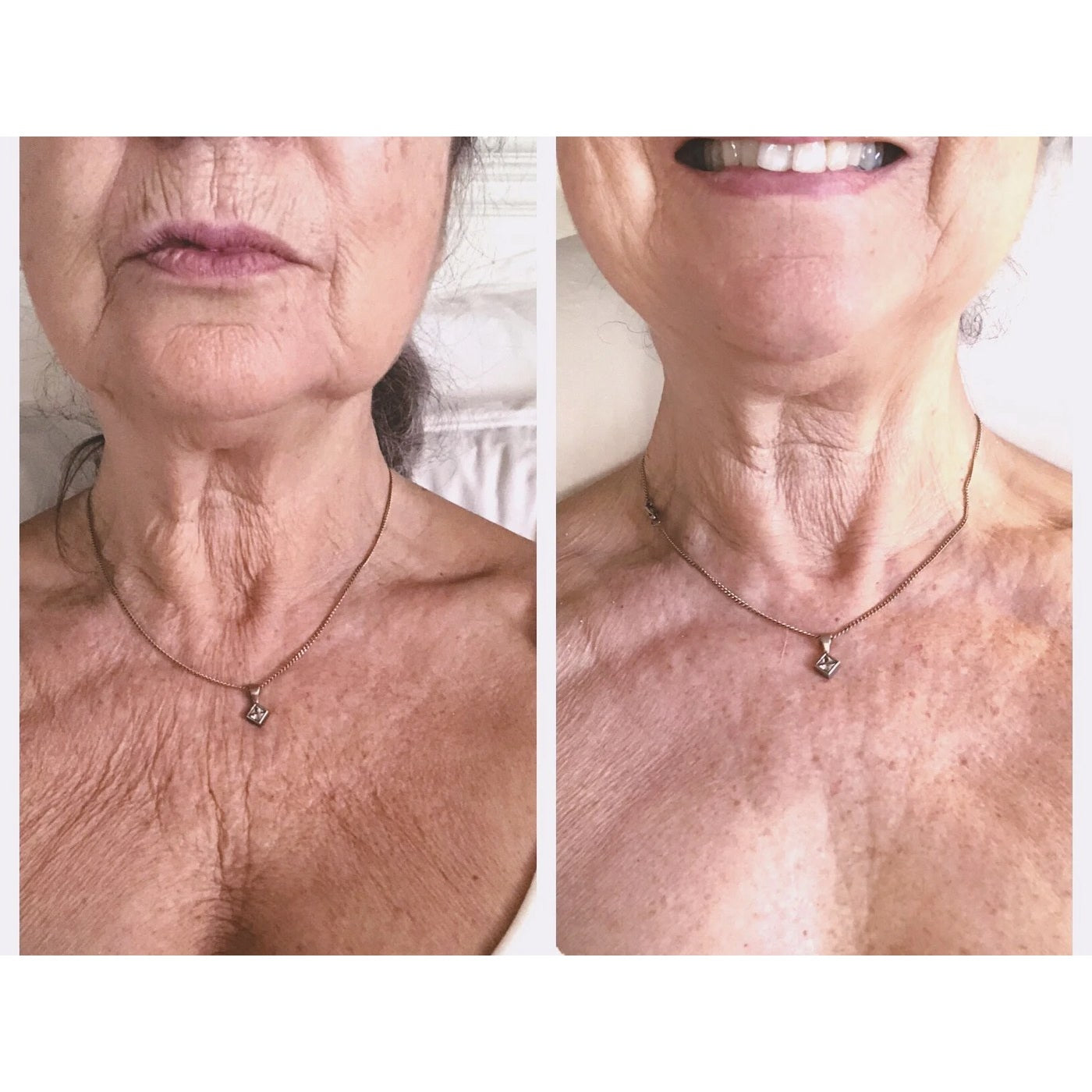 Neck and décolleté, week 6, before and after, RAYLIFT MicroSeal