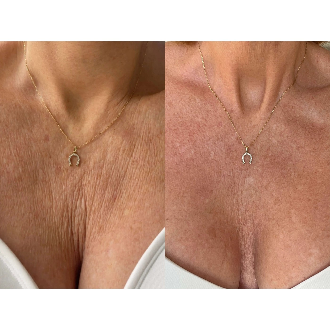 Décolleté, week 8, before and after, RAYLIFT MicroSeal