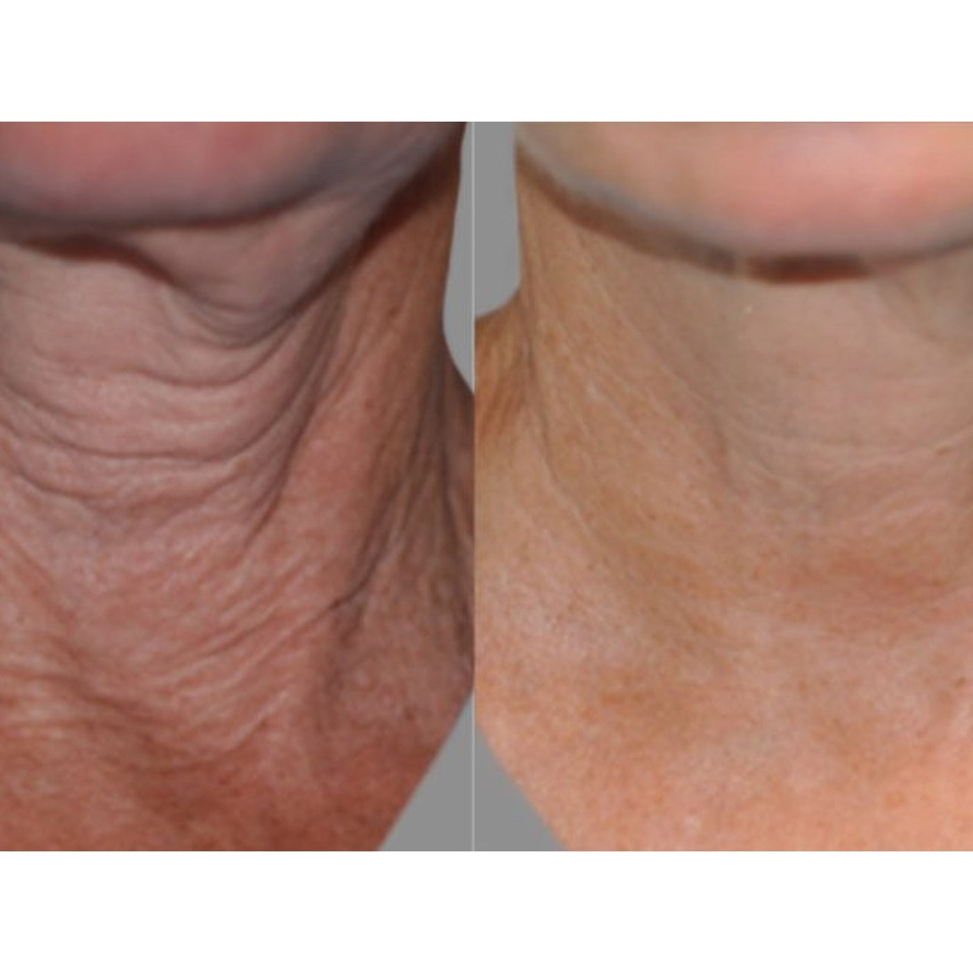Front of the neck, week 6, before and after, RAYLIFT MicroSeal