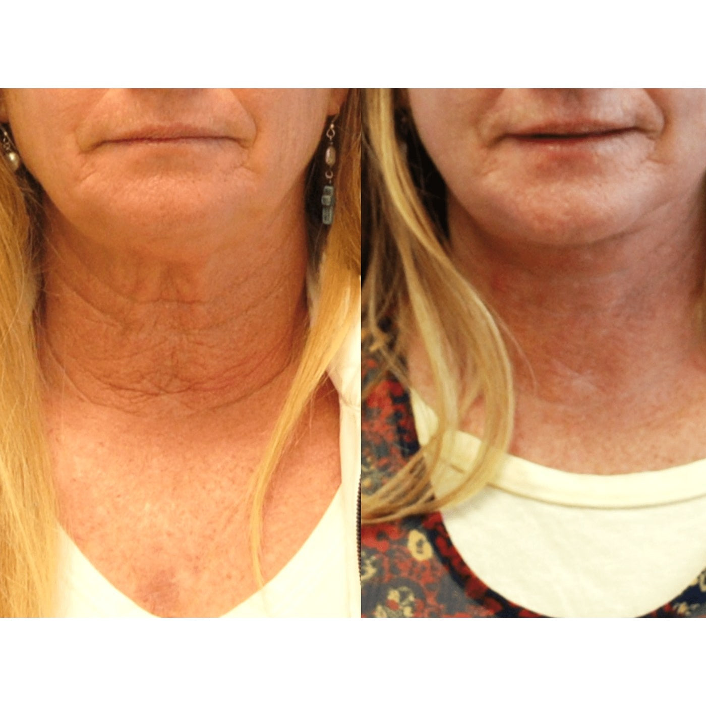 Jawline and neck, week 8, before and after, RAYLIFT MicroSeal