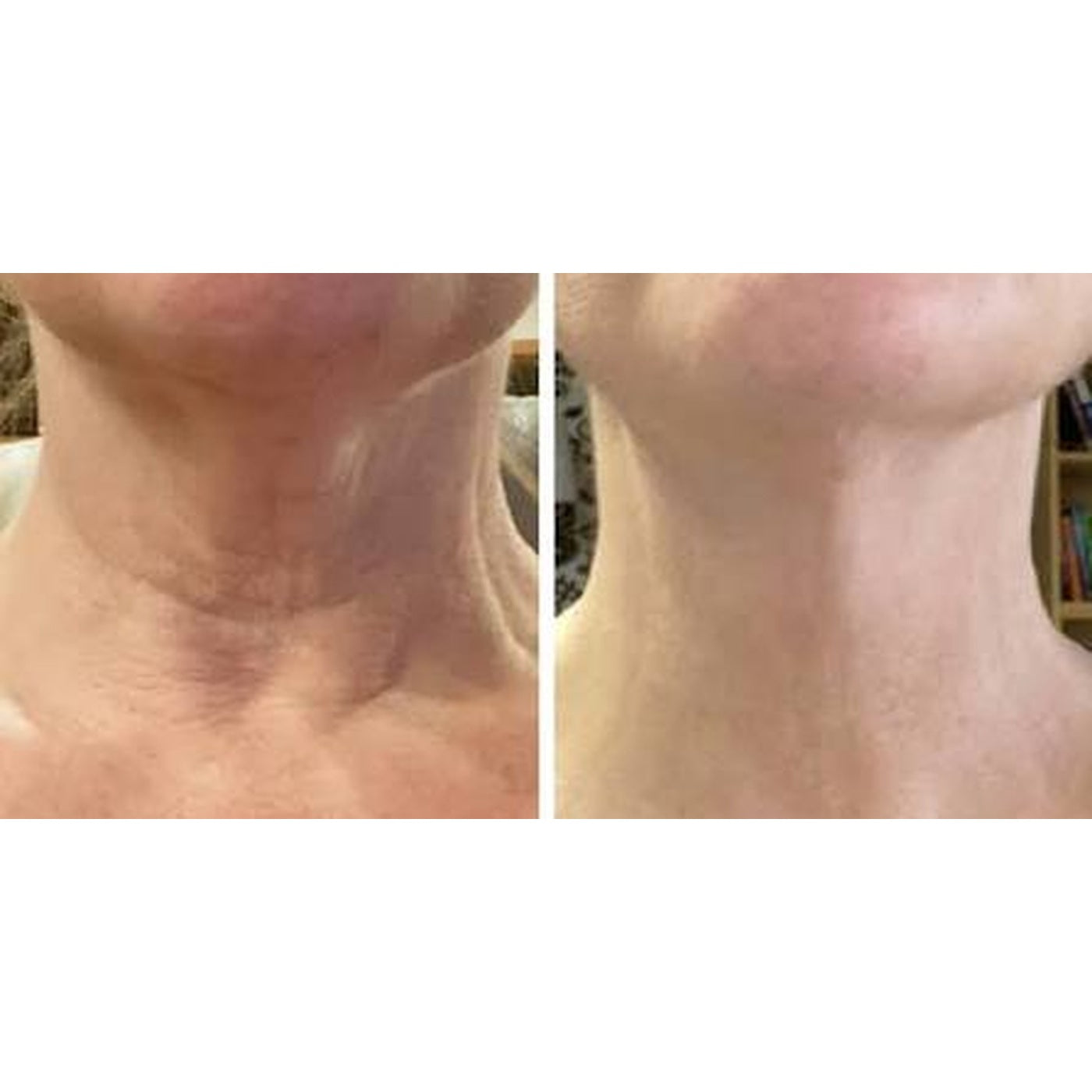 Front of the neck, week 6, before and after, RAYLIFT MicroSeal