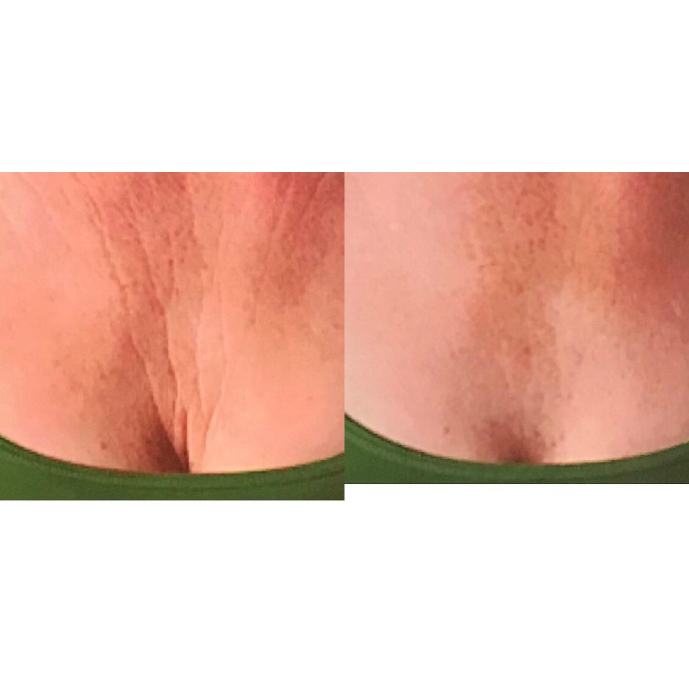 Chest, week 8, before and after, RAYLIFT MicroSeal
