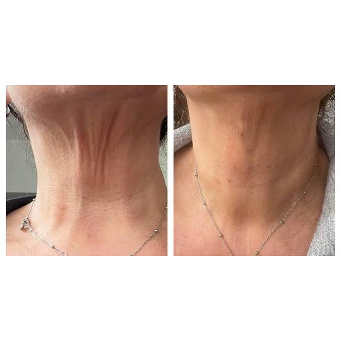 Neck, week 6, before and after, RAYLIFT MicroSeal