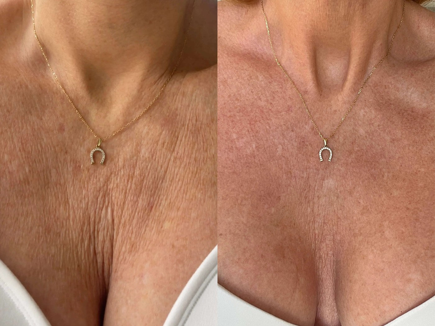 D&eacute;collet&eacute;, before and after