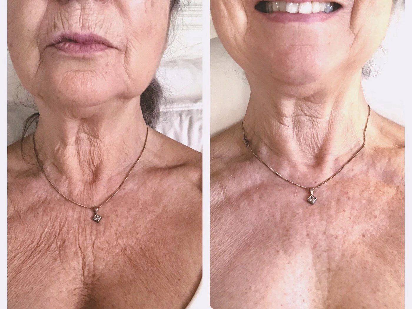 Neck and d&eacute;collet&eacute;, before and after