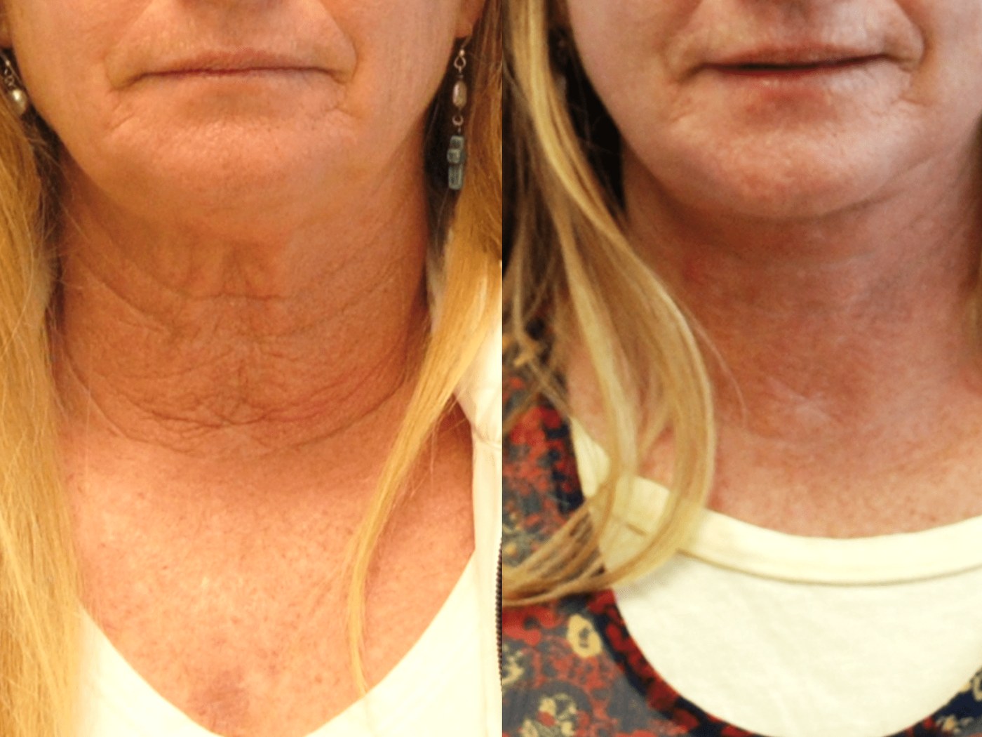 Jawline and neck, before and after