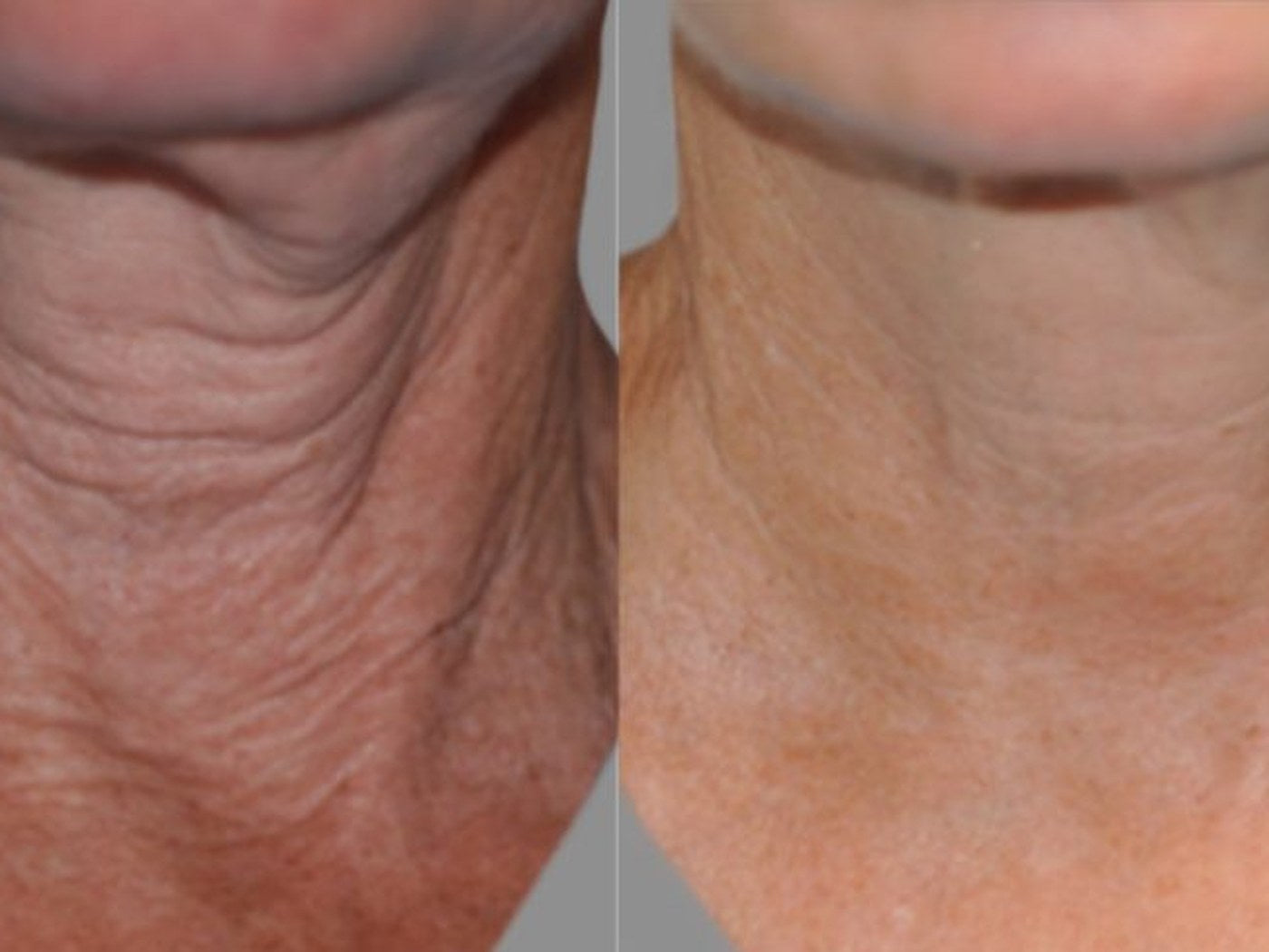 Front of the neck, before and after